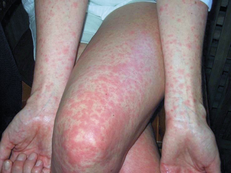 dengue rash