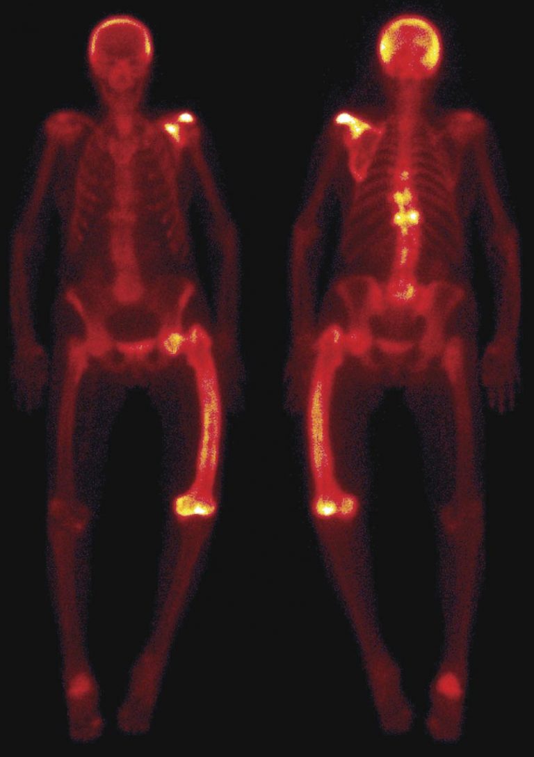 How the presentation of Paget’s disease has changed Medical Forum