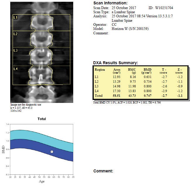 bone density test results