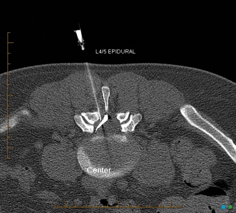 Treatment of low back pain by injection & RF ablation - Medical Forum