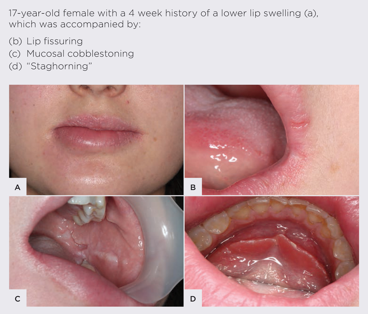 Oral Manifestations Of Inflammatory Bowel Disease Medical Forum 