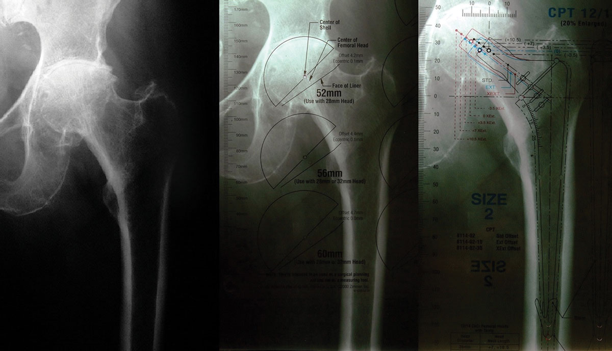 120% AP views used to template prosthesis.