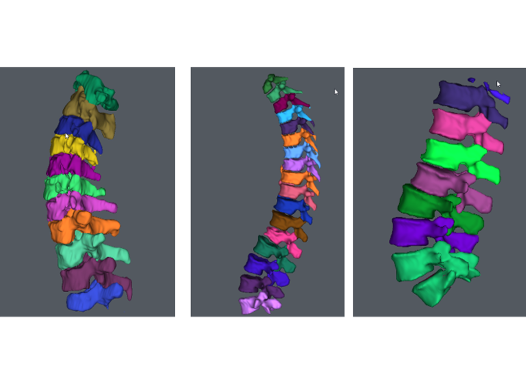 New Technology AI powered Spinal Visualisation Can Save Doctors 