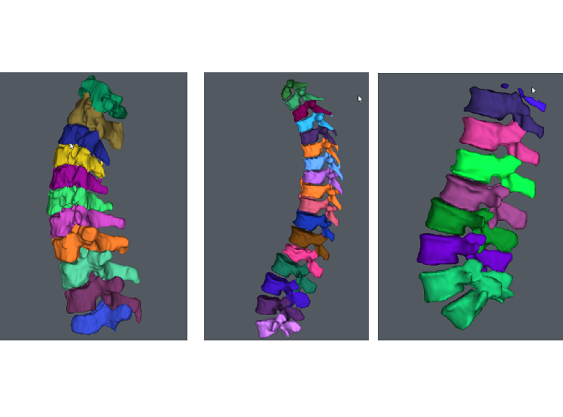 New Technology AI powered Spinal Visualisation Can Save Doctors 