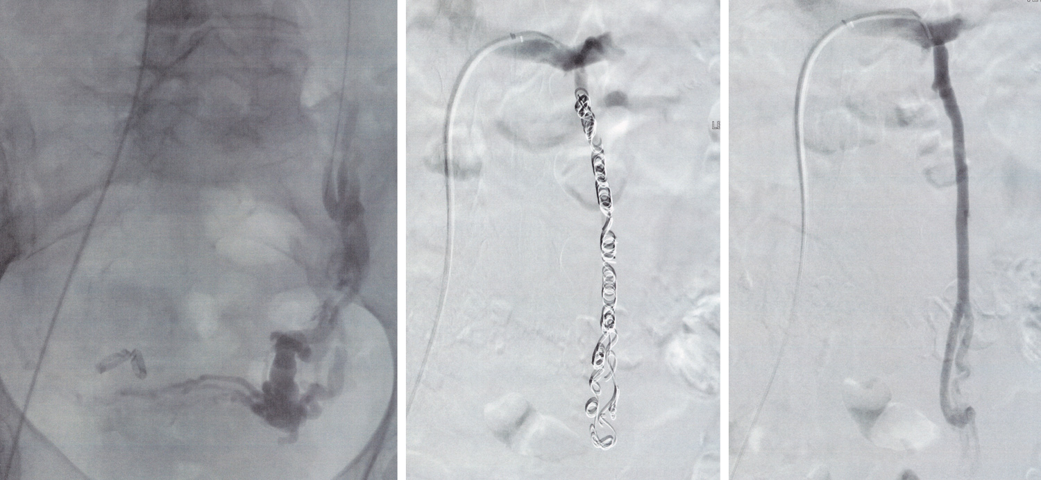 Pelvic venous congestion - Medical Forum
