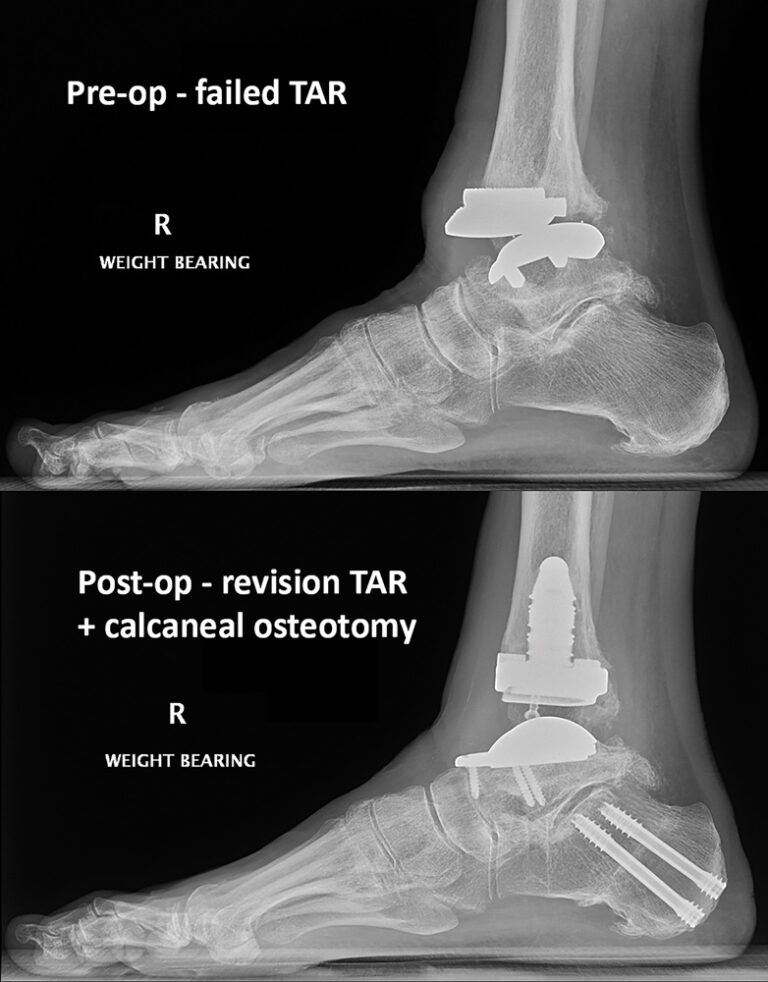 New frontiers in foot surgery and total ankle replacement Medical Forum