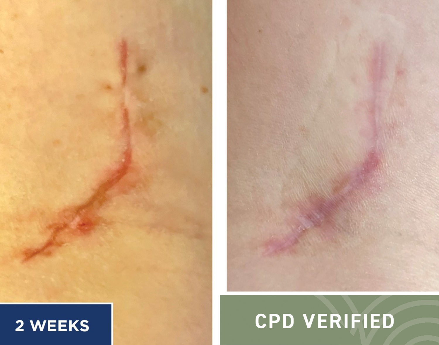 Preventing problematic scars – a clinical guide