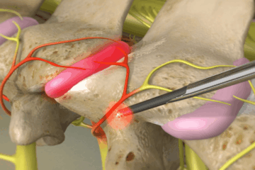 RFA electrode targeting spinal medial branch nerve to alleviate facet joint arthropathy pain. Performed under CT guidance with local anaesthetic.