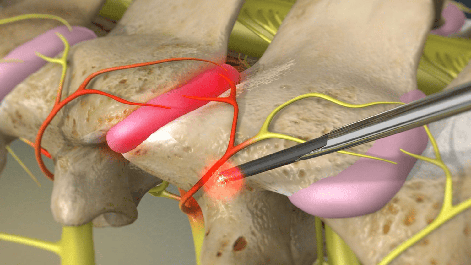 RFA electrode targeting spinal medial branch nerve to alleviate facet joint arthropathy pain. Performed under CT guidance with local anaesthetic.