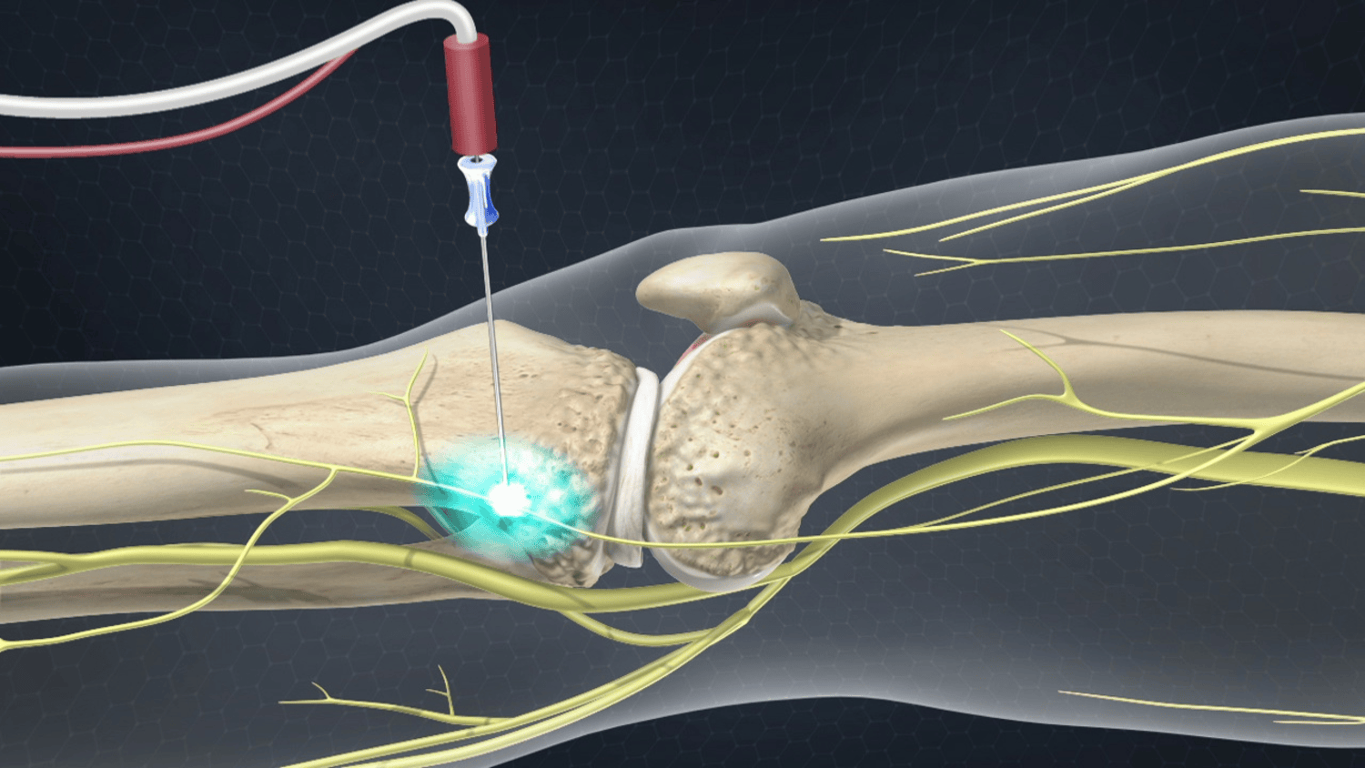 RFA electrode targeting inferior genicular nerve as part of knee OA procedure requiring 3 genicular nerve ablations under local anaesthetic.